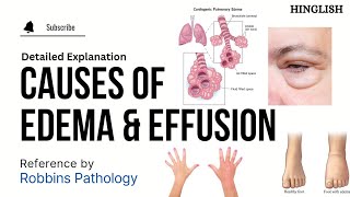 Edema Oedema  Part 2  Causes Of Edema  Hemodynamic Disorders Pathology  KTC MBBS [upl. by Larrie]