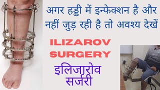 Ilizarov Surgery for bone infection and gap nonunion हड्डी के न जुड़ने और इन्फेक्शन का इलाज इलिजारोव [upl. by Eednil]