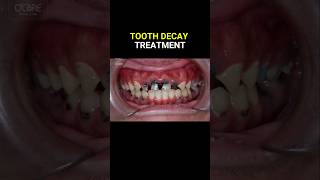 Tooth decay treatment dentist dentistry caries filling [upl. by Charley]