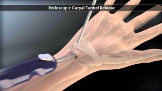 Tratamentul sindromului de tunel carpian [upl. by Enowtna]