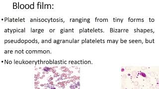 Essential Thrombocythemia [upl. by Ihculo]