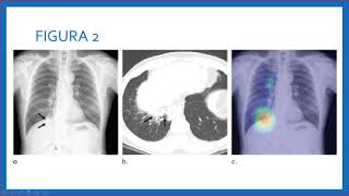 APRENDIZAJE PROFUNDO CON RADIOGRAFÍAS DE TÓRAX EN EMERGENCIAS [upl. by Barnie]