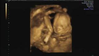 18 weeks pregnant ultrasound [upl. by Hal]