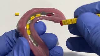 Changing Hader Clips to Increase Denture Stability [upl. by Sabas]