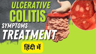 Ulcerative colitis symptoms and treatment  Inflammatory bowel disease [upl. by Orofselet983]