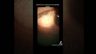 Scleral contact lens over a keratoconus cornea Keratoconus Sclerallens Cornealring CXL Intac [upl. by Duile]