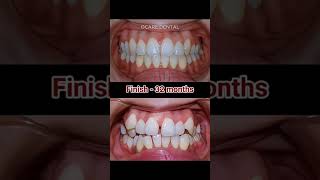 Braces animation 32months braces orthodontist dental dentistry dentist [upl. by Ordnagela]