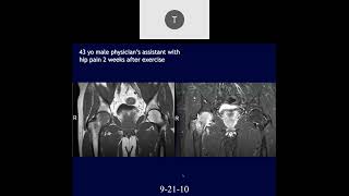 MRI of the Hip Part 2 – Hip Trauma [upl. by Toy]