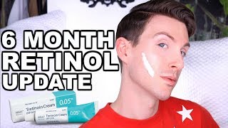 FIRST 6 MONTHS ON RETIN A  BEFORE AND AFTER TRETINOIN CREAM [upl. by Obie774]