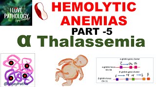 Hemolytic Anemias Part 5 Alpha Thalassemia Pathogenesis types Diagnosis amp Treatment [upl. by Felske776]