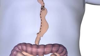 Esophagectomy Procedure Animation [upl. by Kcub]