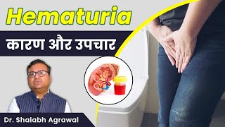 ❇️पेशाब में खून आने का कारण  What is Hematuria 🔰Blood in Urine Hematuria Symptoms And Treatment [upl. by Qifahs845]