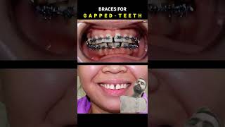 Braces for Gapped teeth 32 month Duration dentist braces orthodontist [upl. by Peck]