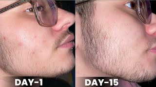 Day1 to day15 minoxidil beard growth results  minoxidil beard growth  derma roller for beard [upl. by Elwaine]