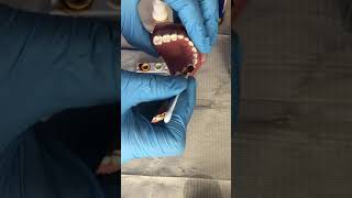 How to apply Povidone Iodine to teeth [upl. by Eiddet130]