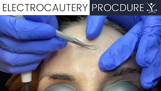 Watch an Electrocautery Procedure [upl. by Fiertz954]