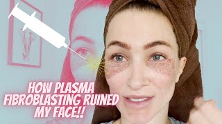 Did Plasma Fibroblast Ruin My face [upl. by Eiggem530]