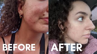 DID DOXYCYCLINE WORK  My Doxycycline Experience Doxycycline for Acne Before and After Pictures [upl. by Annaert]