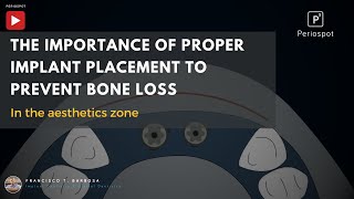 The importance of proper implant placement to prevent bone loss [upl. by Hinch]