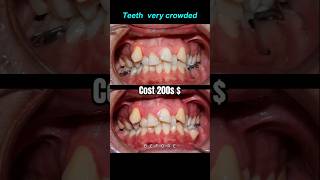 Crowded teeth Braces transformation braces orthodontist dentist bracket [upl. by Radnaskela]