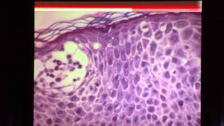 Dermatopathology Pearls Inflammatory Dermatoses [upl. by Ymar11]