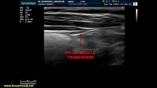 Quadratus lumborum QLB block [upl. by Athalee]