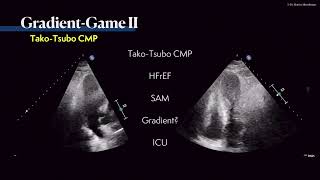 〖Echocardiography〗 Where is the gradient 💘 💫 [upl. by Flight]