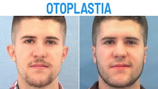 Otoplastia Masculina Antes y Después  Clínicas Diego de León [upl. by Ellenoj]