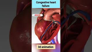 congestive heart failure shorts medical heart humanbody 3d treatment biology [upl. by Deena]