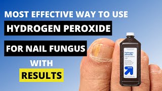 3 Ways to Use Hydrogen Peroxide for Nail Fungus  Toe Fungus Journey [upl. by Akiner]