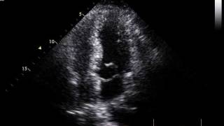 excess mitral tissue moving into the LVOT without subaortic obstruction [upl. by Ahseena]