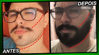 EVOLUÇÃO MINOXIDIL 1 ANO E 4 MESES Pant Foligain e Kirkland [upl. by Henricks40]