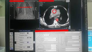 PROTOCOLO DE TÓRAX  ANGIOTOMOGRAFIA DE AORTA TORÁCICA [upl. by Mimajneb]