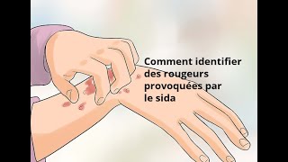 Comment identifier des rougeurs provoquées par le sida [upl. by Suiratnod]