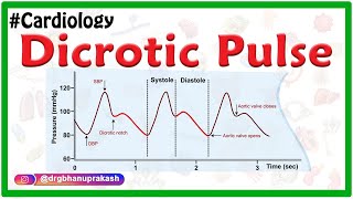 Dicrotic pulse  Internal medicine  Usmle Cardiology [upl. by Noonberg628]