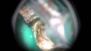 Endodontic Access Maxillary First Molar [upl. by Helyn755]