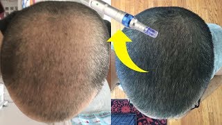 BEST MICRONEEDLING DEVICE FOR HAIR GROWTH [upl. by Longawa]