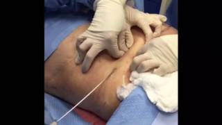 Tumescent Liposuction for Fat Removal [upl. by Tomlin251]