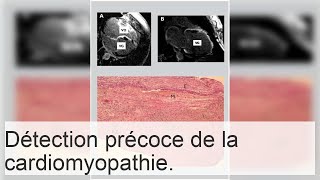 Causes et diagnostic de la sclérose cardiaque diffuse [upl. by Severen]