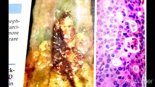 GIT Pathology 3 Major Topic Esophageal Adenocarcinoma and Squamous cell Carcinoma [upl. by Otto]