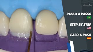 Diastema and Incisal Increase I Diastema y Alargamiento Incisal I Diastema e Aumento Incisal [upl. by Fabrice406]