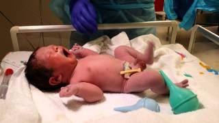 Baby 3 Live Birth in 4K UHD Video Csection Operation Delivery camera recording [upl. by Eben932]