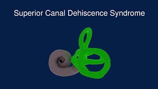 Superior Canal Dehiscence Syndrome SCDS [upl. by Meelas103]