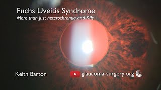 Fuchs Uveitis Syndrome  The Clinical Features  More than Heterochromia and KPs [upl. by Einittirb]