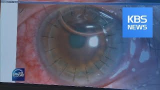 NEW TECHNIQUE FOR CORNEAL TRANSPLANT  KBS뉴스News [upl. by Dirfliw]