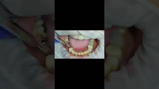 Lower molars replaced with 2 Simpladent KOS impalnts post 6 months tapping test shorts [upl. by Anaiad]