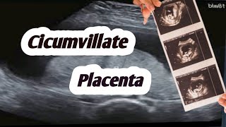 Circumvallate placenta on ultrasoundplacental abnormalities [upl. by Stephi]