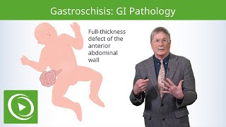 Gastroschisis GI Pathology  Epidemiology Pathophysiology Diagnosis amp Treatment [upl. by Meredithe]