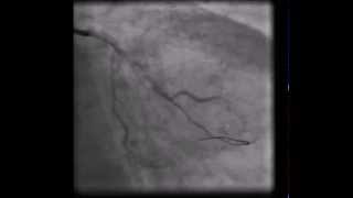 Concertina effect during coronary angioplasty [upl. by Nadaba496]