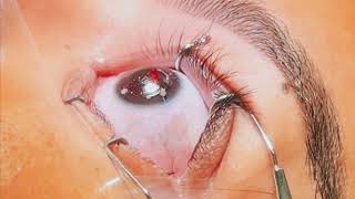 Eye Surgery  laser eye surgery  lasik eye surgery [upl. by Koralle966]